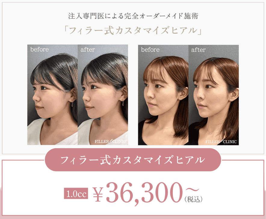 フィラークリニックのカスタマイズ注入